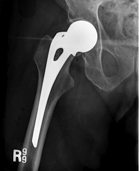 Hip Hemiarthroplasty LLD